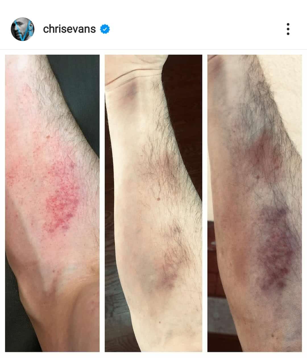 Chris Evans mostra hematona no braco apos se machucar em novo filme Reproducao