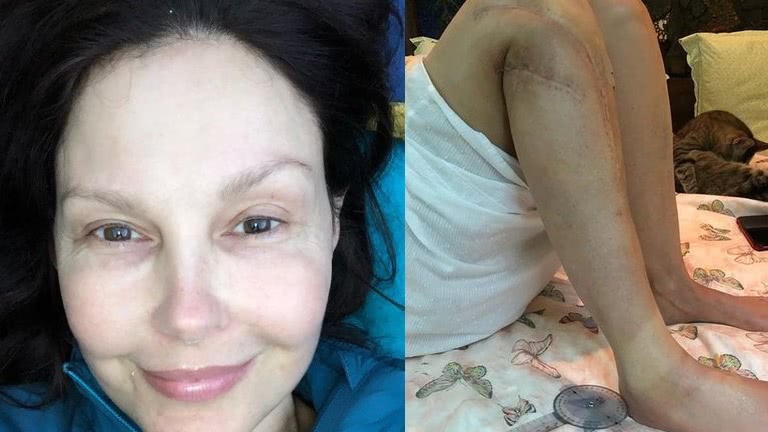 Ashley Judd mostra cicatrizes nas pernas